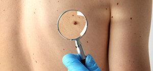 Получи ответ: где в Одессе можно будет бесплатно проверить родинку