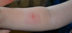 В Днепропетровской области зафиксировать 8 случаев опасной болезни: как уберечься