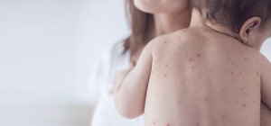 На Буковине у трехлетнего ребенка обнаружили корь: врачи бьют тревогу из-за возможной вспышки