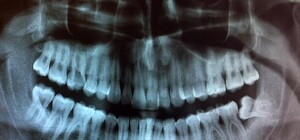 Просветят все: в жилых домах разрешили использовать оборудование для рентгена